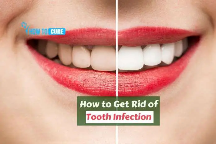 How to Get Rid of a Tooth Infection without Antibiotics: Magical ...