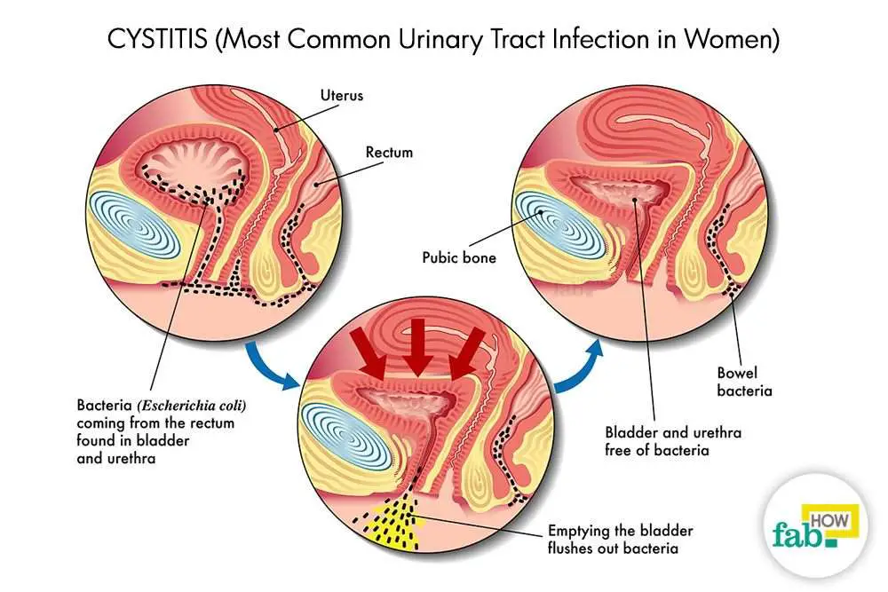 How to Get Rid of a UTI without Antibiotics