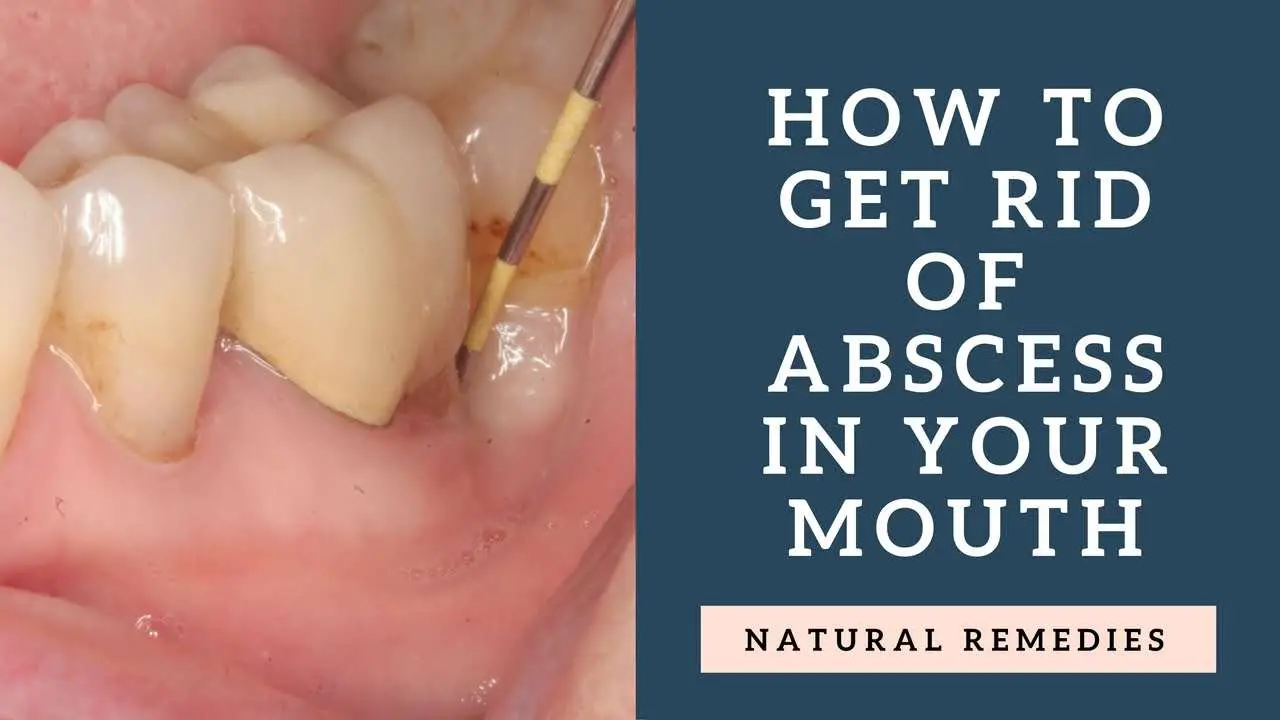 How to Get Rid of Abscess