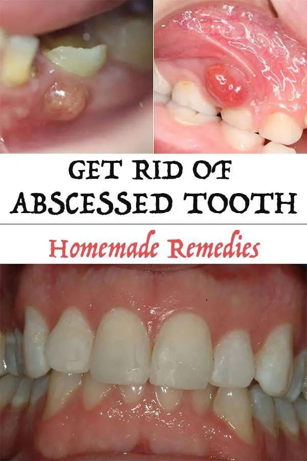 How to Get Rid of Abscessed Tooth