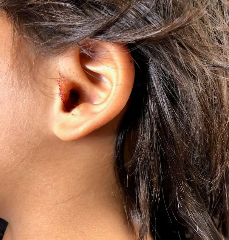 HOW TO GET RID OF EAR INFECTION WITHOUT ANTIBIOTICS