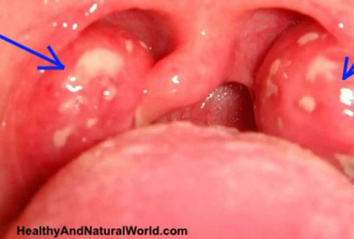 How To Get Rid of Strep Throat Faster And Better Without Antibiotics ...