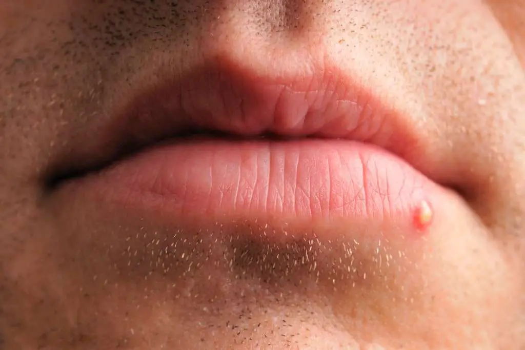 How to Identify a Herpes Cold Sore vs. Pimple â Expert Advice