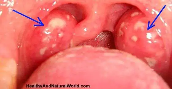 How To Naturally Get Rid Of Strep Throat