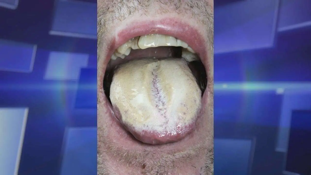 Is Oral Thrush Caused by Antibiotics?