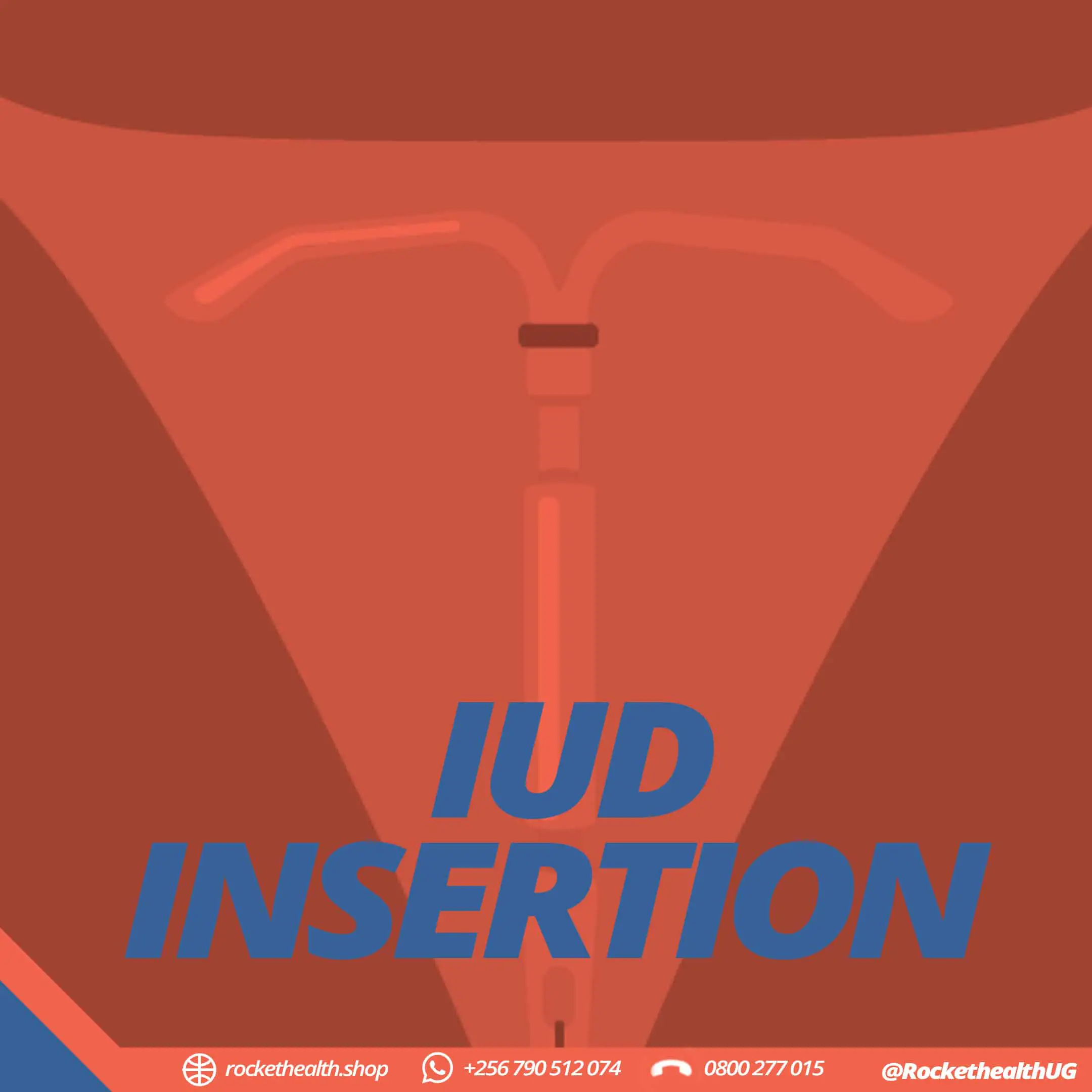 IUD insertion