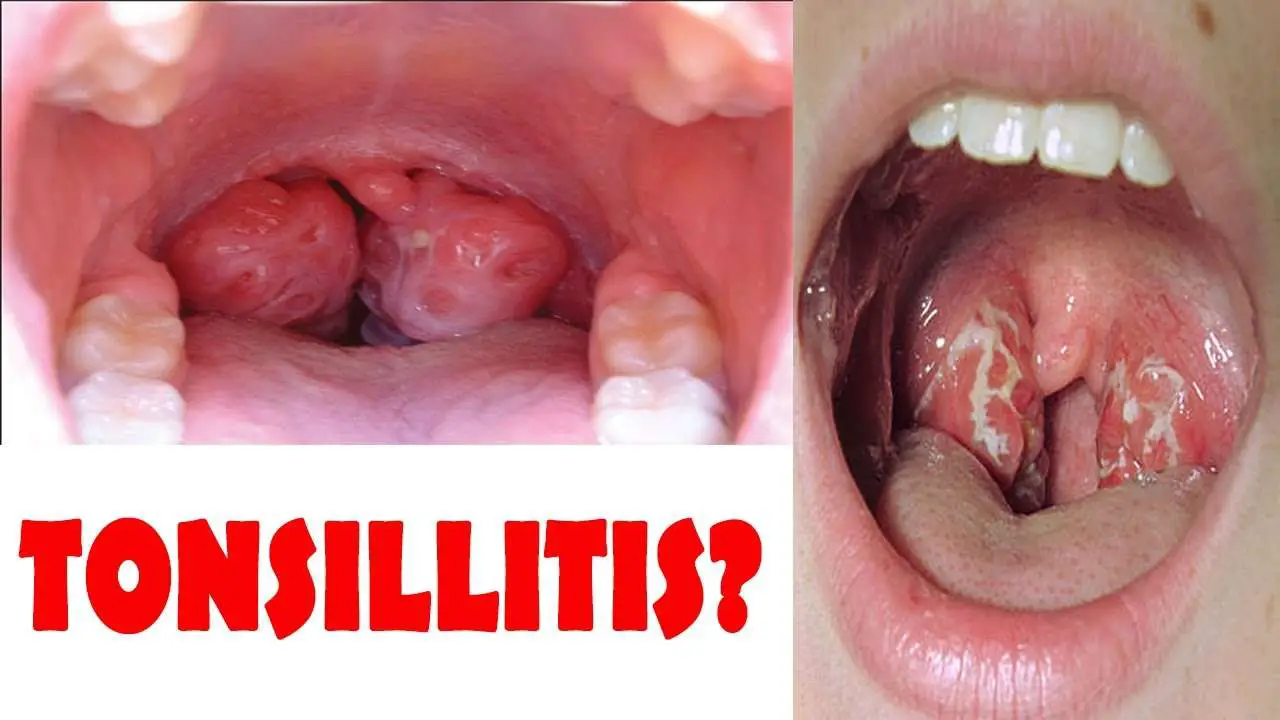Learning Petals: how to get rid of tonsillitis without antibiotics?