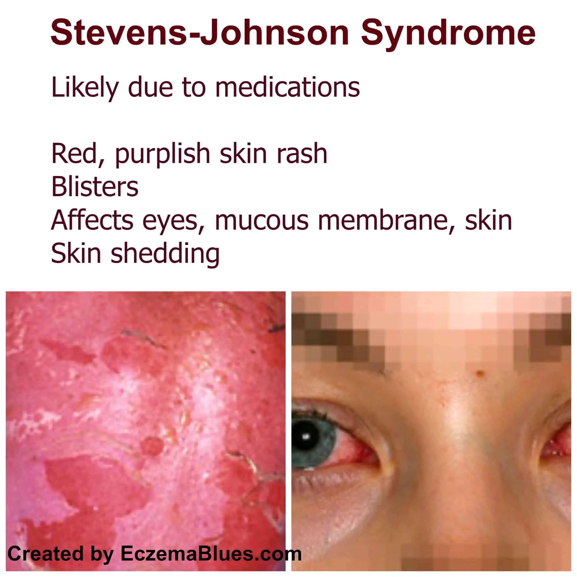 Life Threatening Skin Rash series  Stevens Johnson Syndrome
