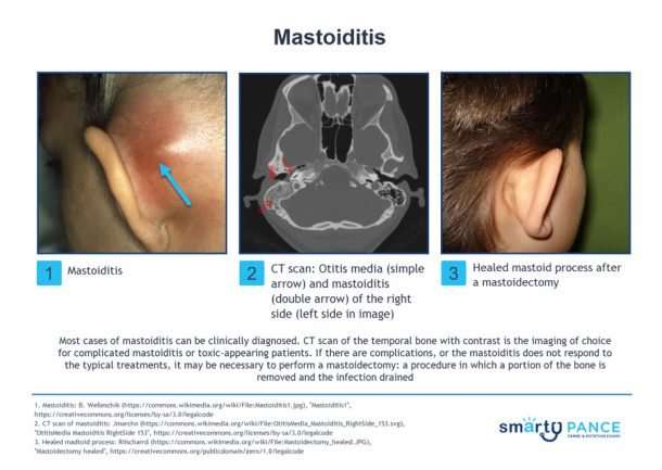 Mastoiditis (ReelDx)