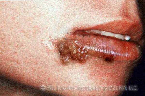 Miracle Herpes Cold Sore Treatment Starts Drying Outbreaks ...