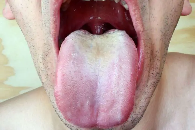 Oral Thrush Causes: Antibiotics