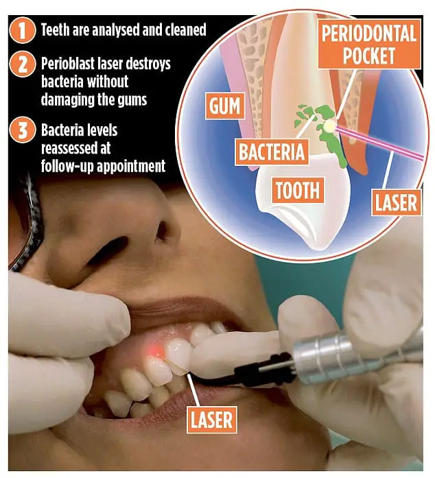 Perioblast could help millions of Brits eradicate chronic gum disease ...