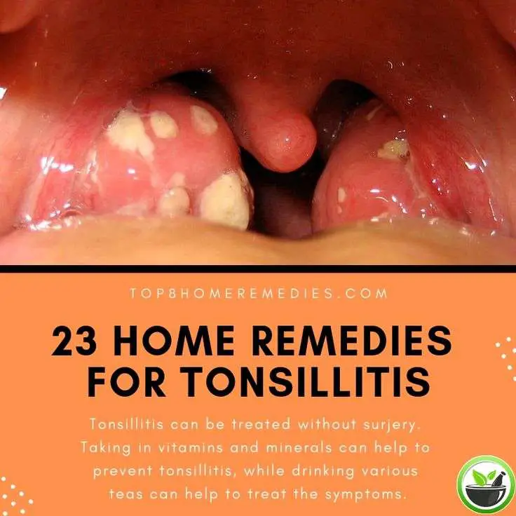 Persistent Sore Throat And Burping Remedy Tonsils _ V