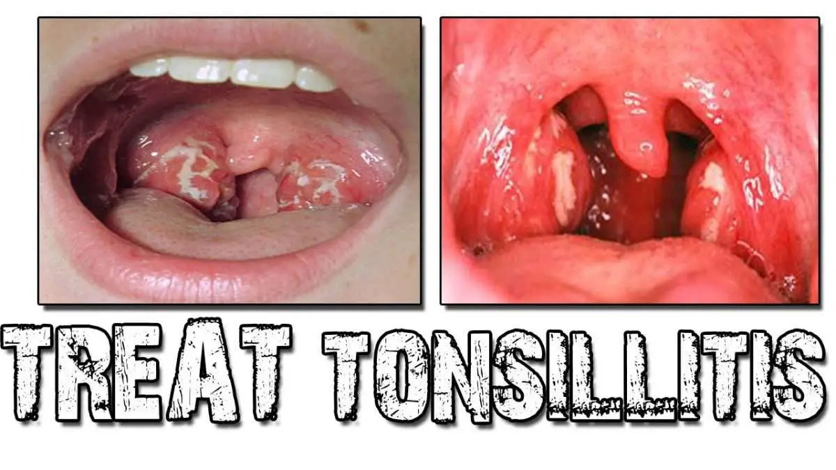 Rationale Treatment of Tonsillitis and Peritonsillar Abscesses ...