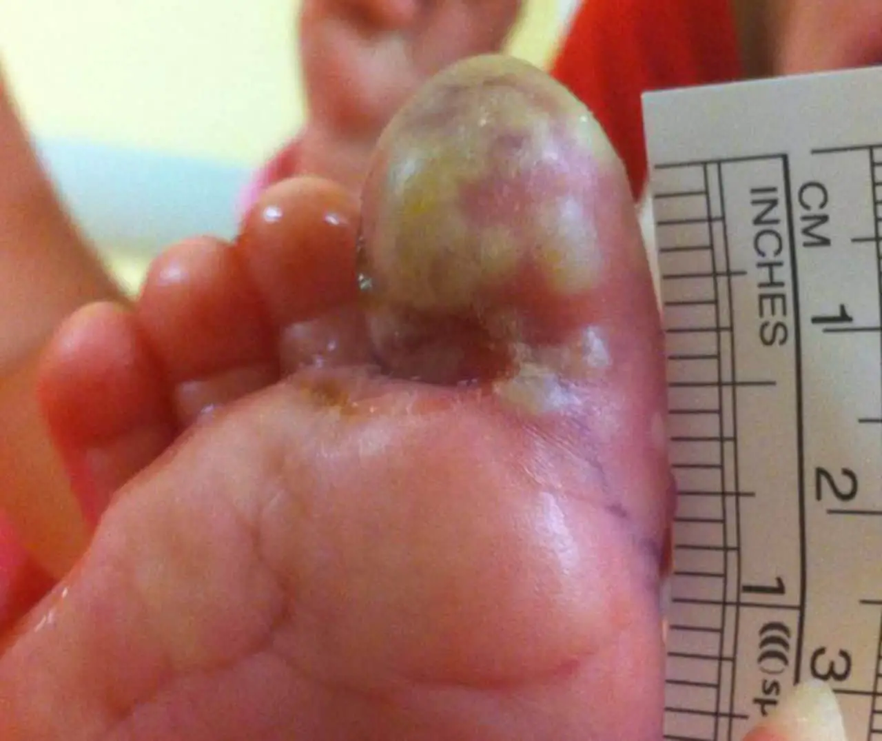 Recurrent primary paediatric herpetic whitlow of the big toe