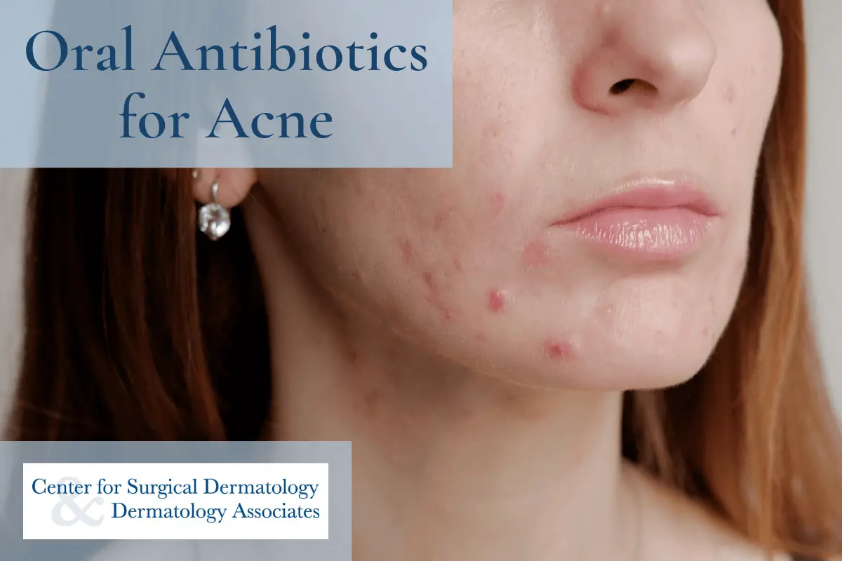 Severe Acne: Antibiotics for Wiping Out Acne for Clear Skin