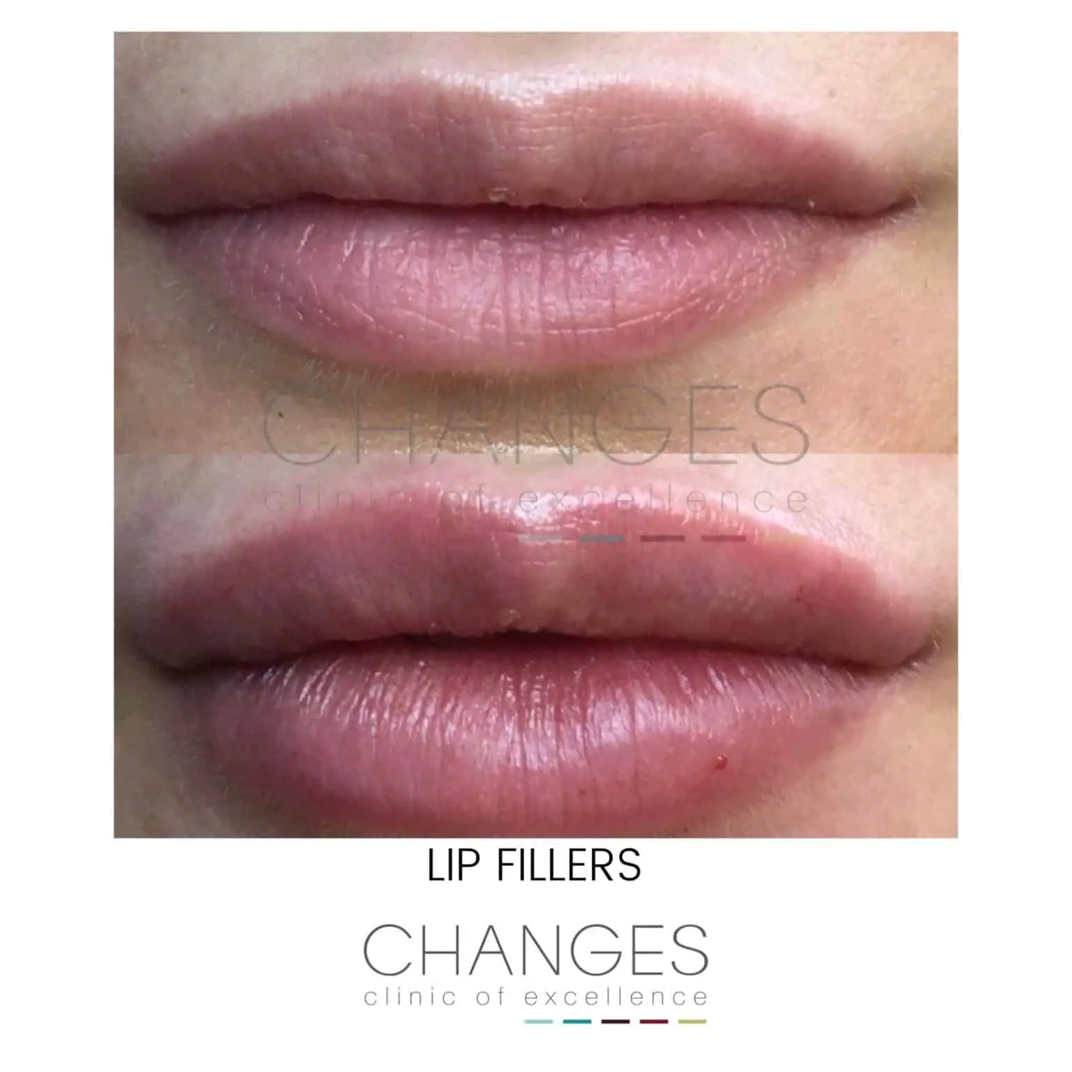 The Trout Pout is Out: Skilled Use of Lip Fillers: