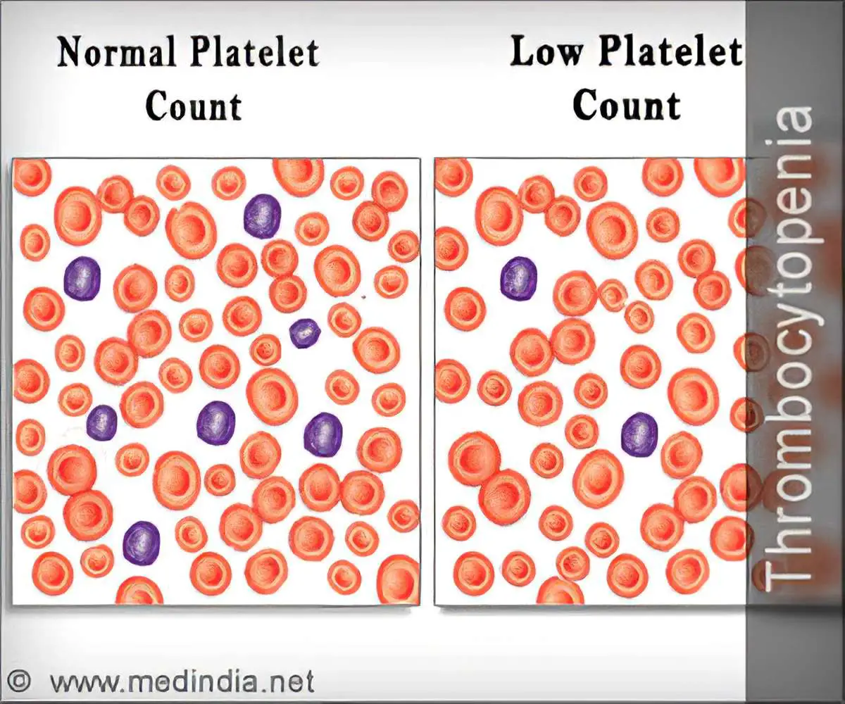 Thrombocytopenia / Low Platelet Count