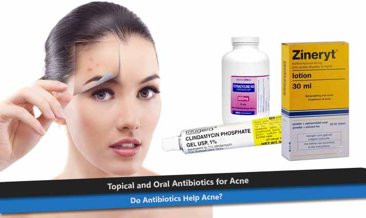 Topical and Oral Antibiotics for Acne