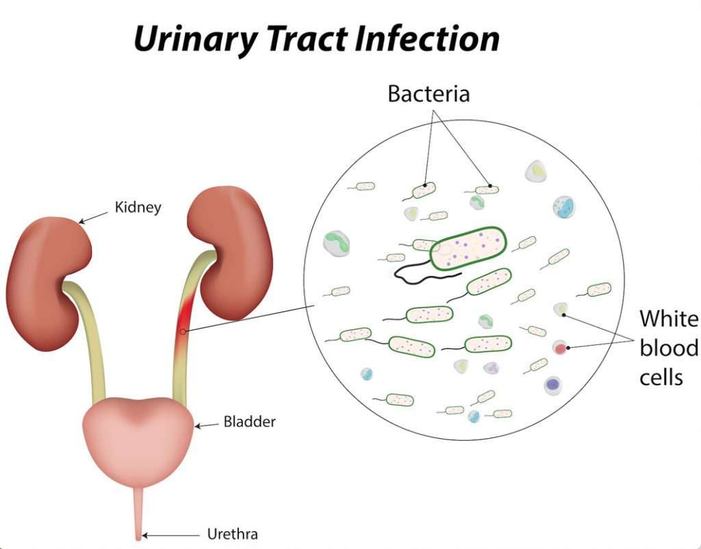 Treating Urinary Tract Infections with Antibiotics