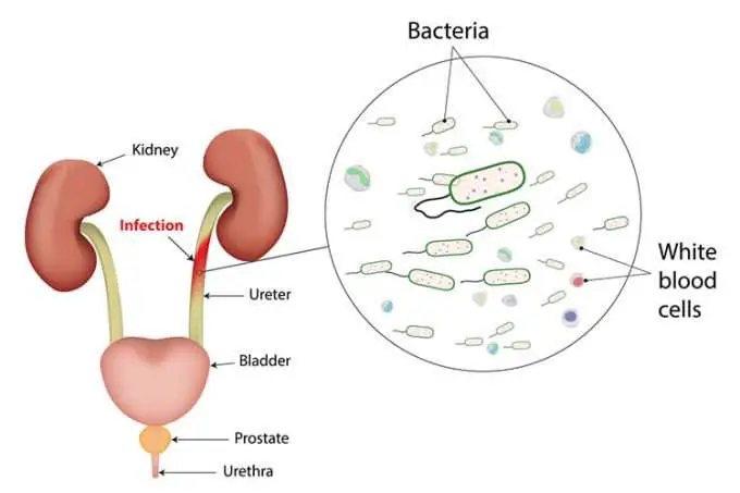 Treating Urinary Tract Infections Without Antibiotics?