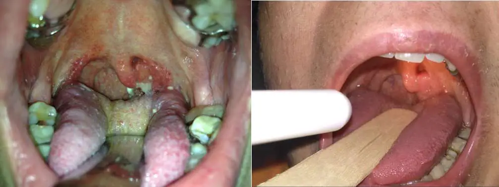 Tuberculous Tonsillitis in a Patient Treated with an Anti