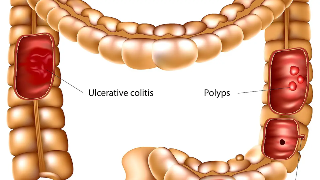 Ulcerative Colitis Medications To Avoid