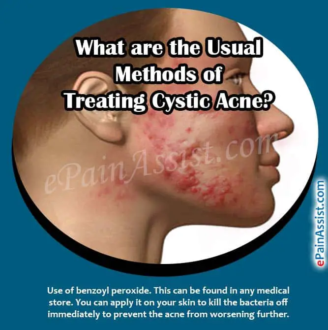 Usual Methods of Treating Cystic Acne &  the Best Antibiotic To Get Rid ...