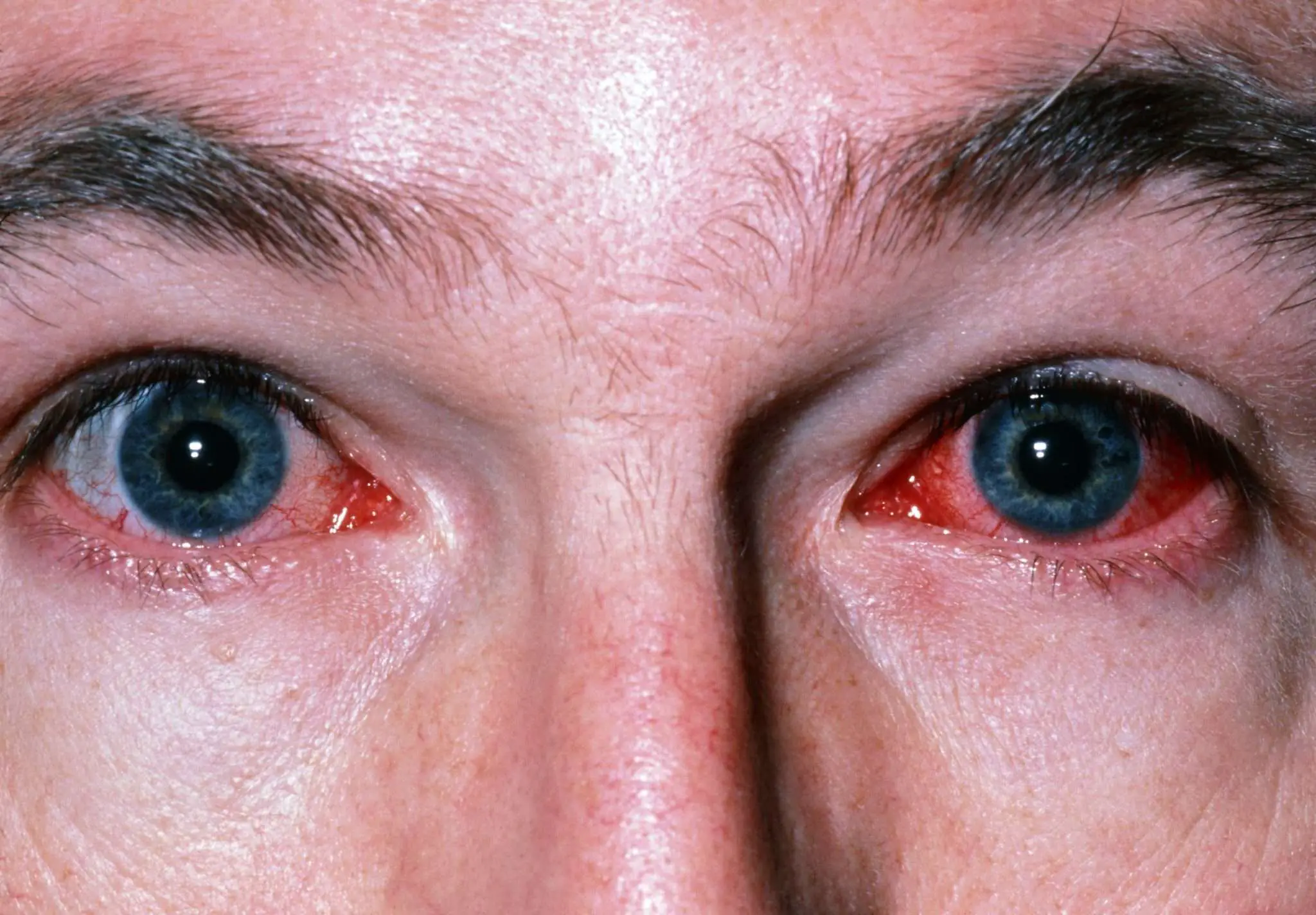 What Is Conjunctivitis