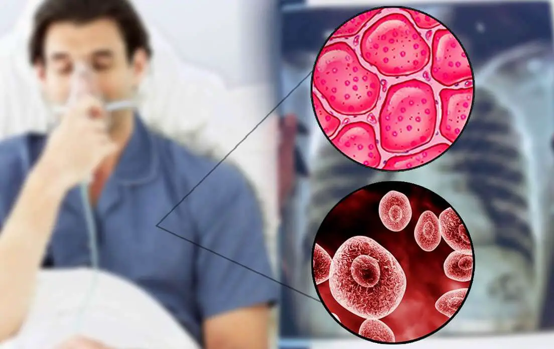 What is Pneumonia Contagious Period After Antibiotics?