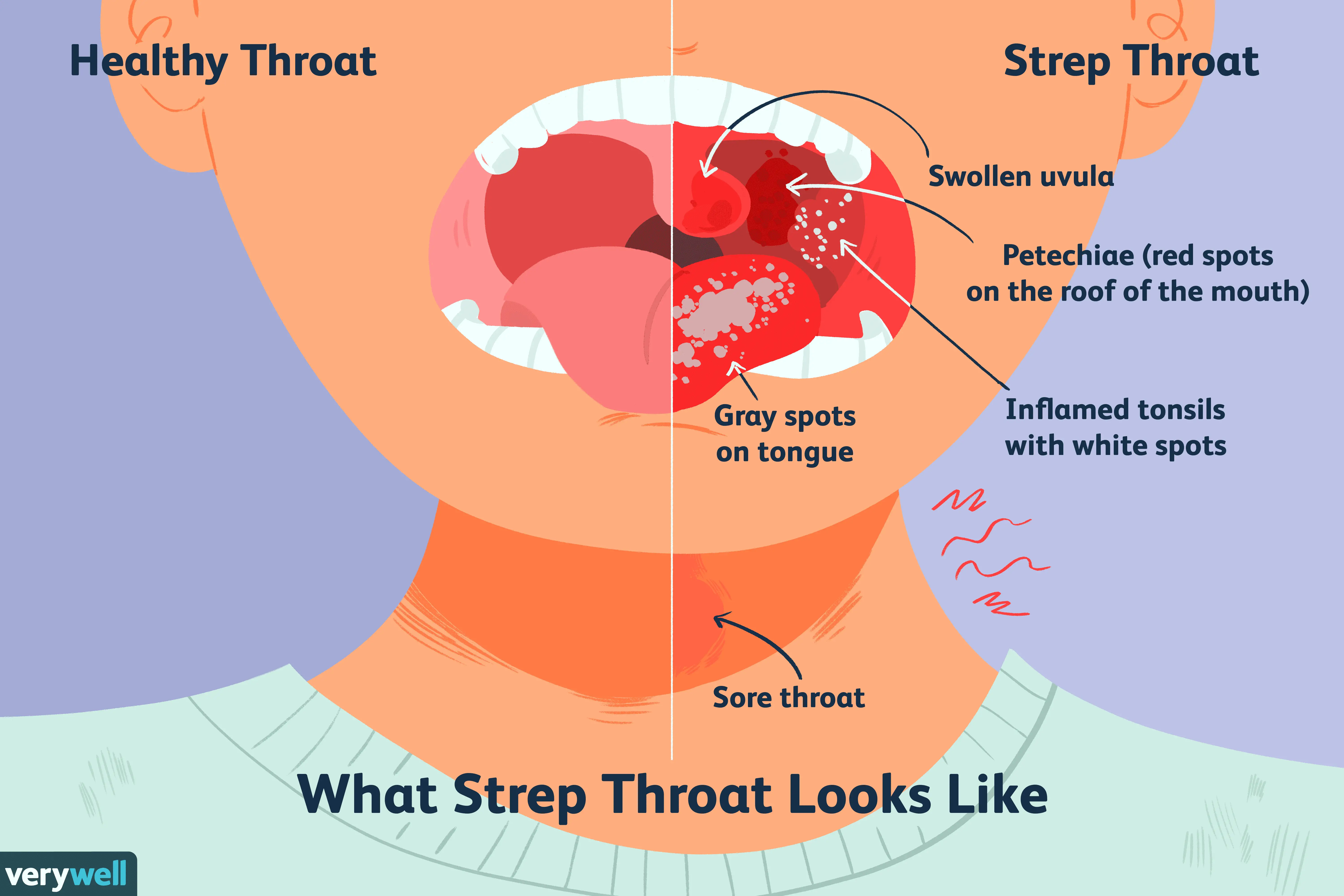 What Is Strep Throat: Overview and More