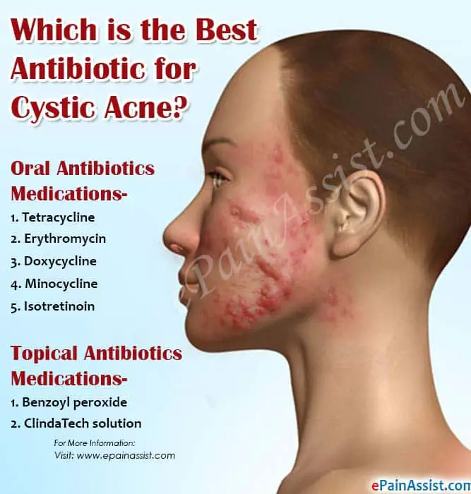 Which is the Best Antibiotic for Cystic Acne?