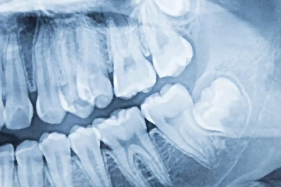 Wisdom Tooth Removal Pain