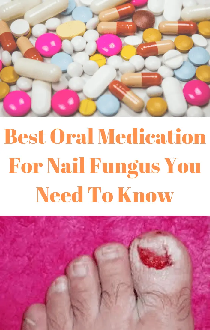 Would You Like To Know Best Oral Medication For Nail Fungus?
